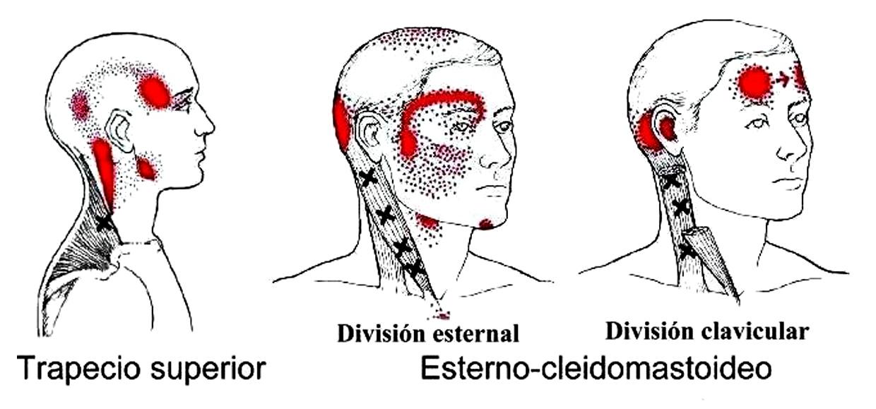 dolor de cabeza