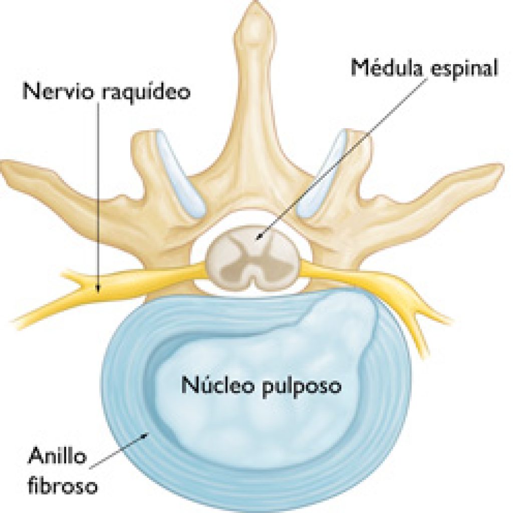 hernia discal