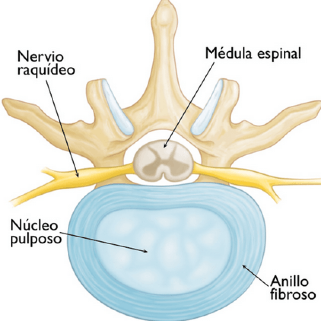 hernia discal