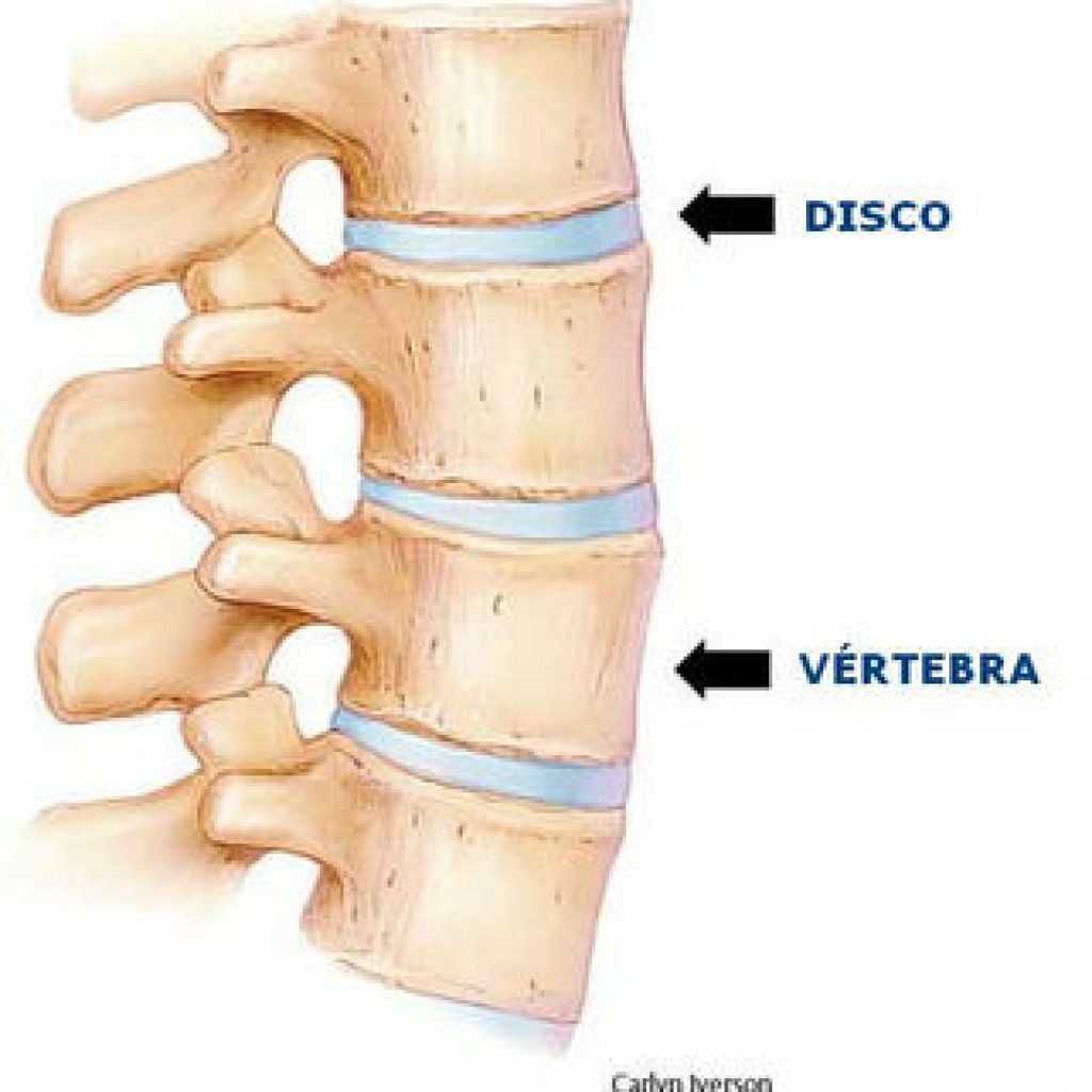 hernia discal