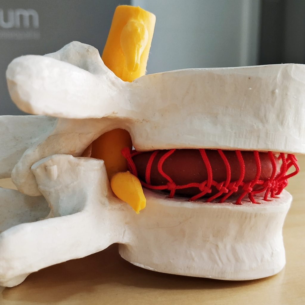 hernia discal