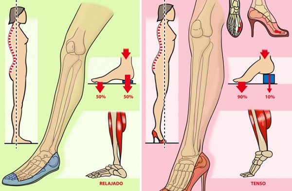 riesgos de usar tacones
