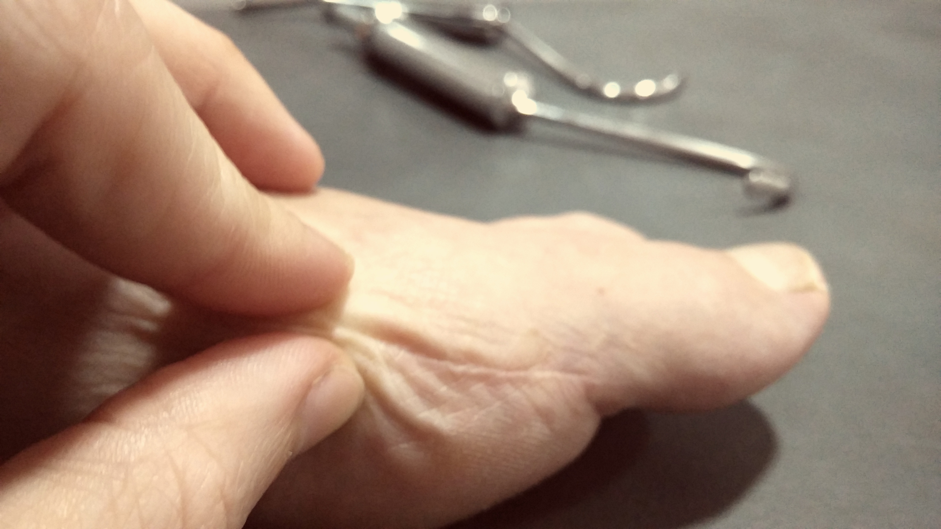 tratar cicatrices con fisioterapia