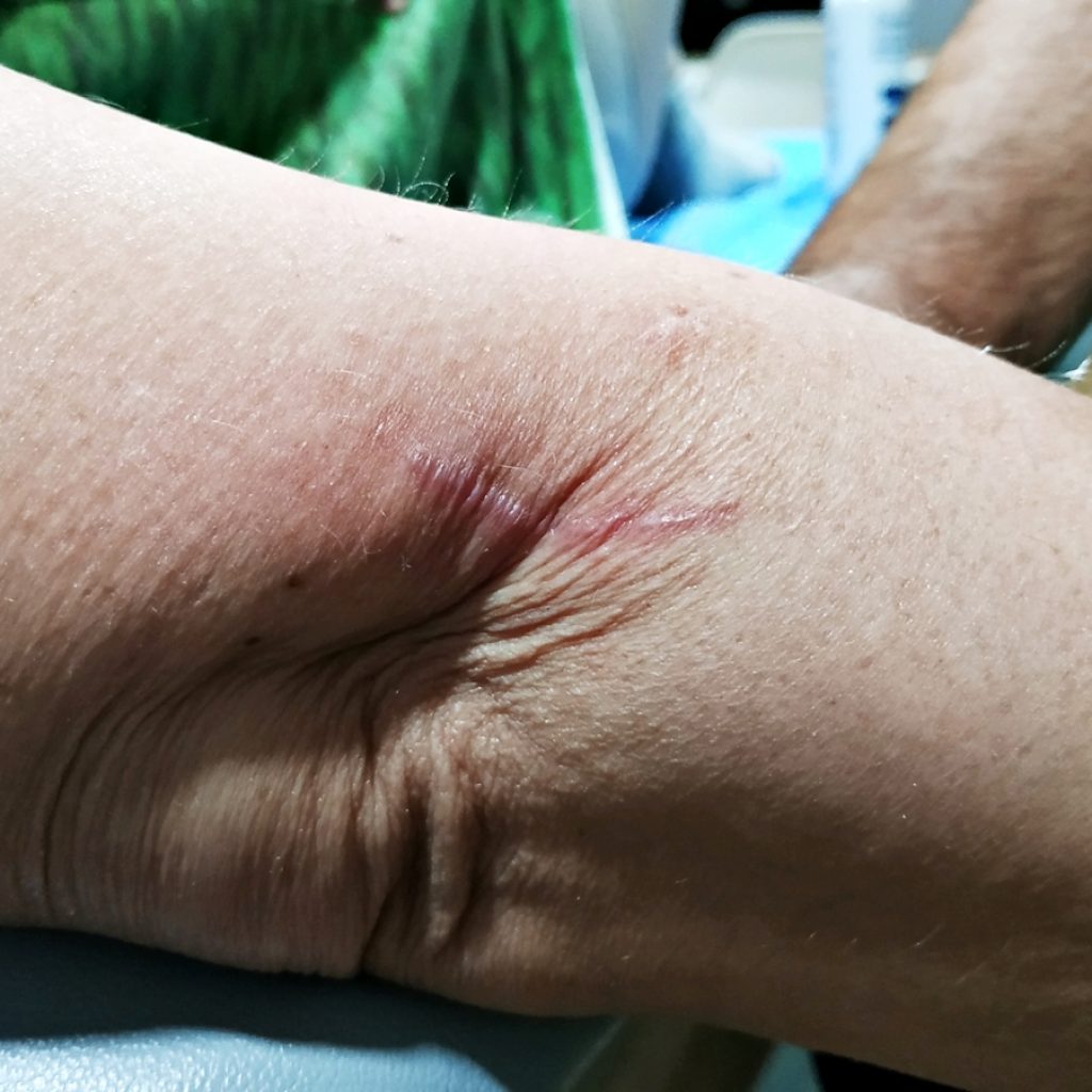 tratar cicatrices con fisioterapia