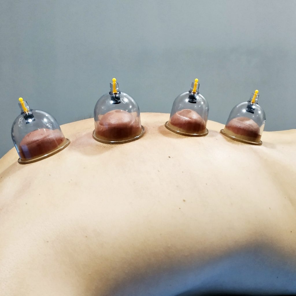 terapia con ventosas