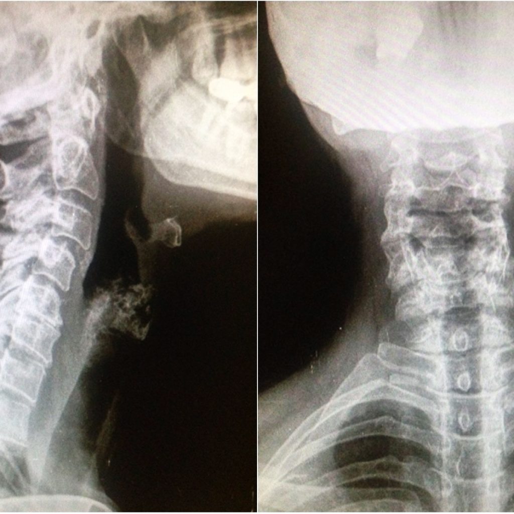 ARTROSIS CERVICAL