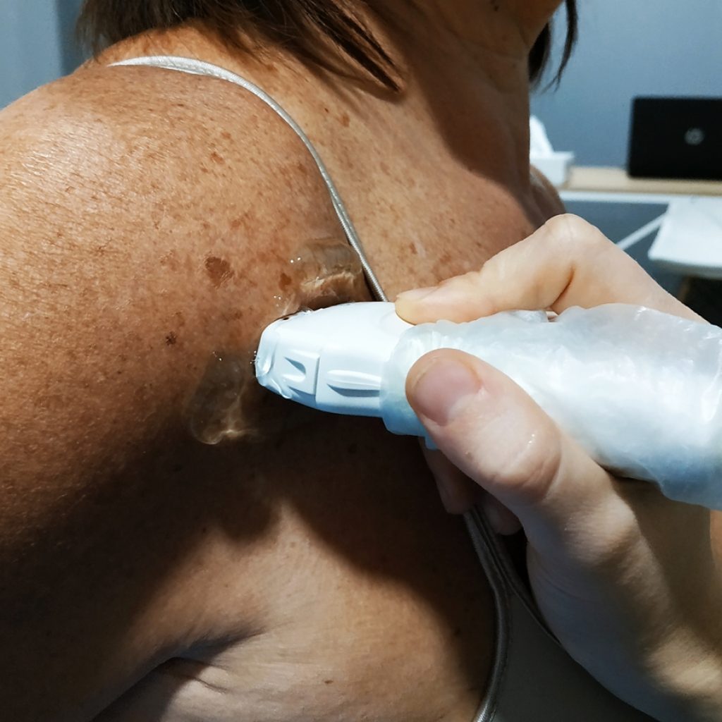 calcificacion tendinosa